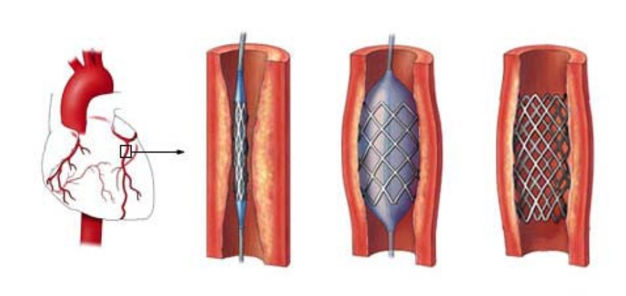 利用冠狀動脈支架(Stents)治療動脈硬化(圖:衛生福利部雙和醫院)